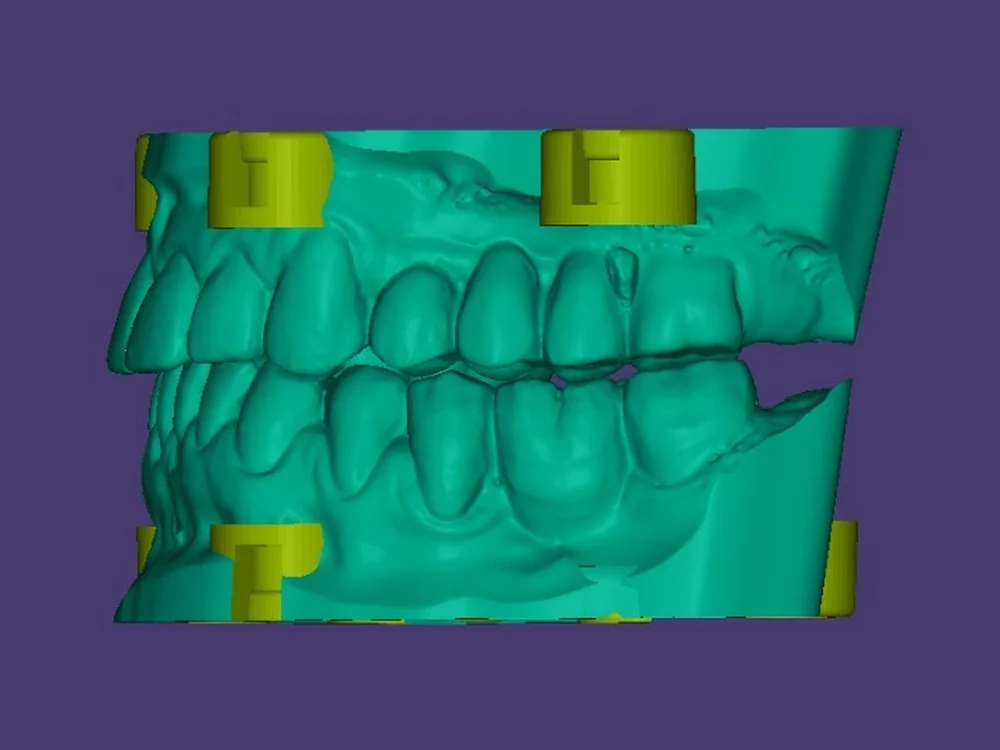 I modelli montati in CAD su exocad, con le basi DACOS